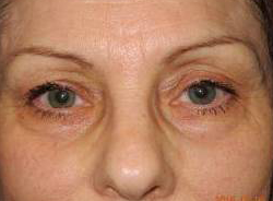 CO2 Laser Resurfacing case #4639