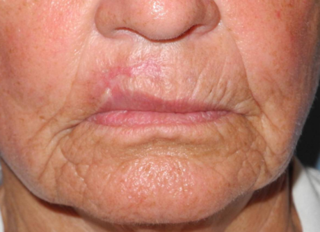 CO2 Laser Resurfacing case #4678