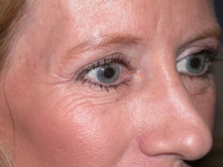 Blepharoplasty case #3938