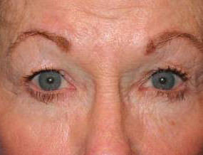 Blepharoplasty case #4729