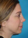 Revision Rhinoplasty case #3465