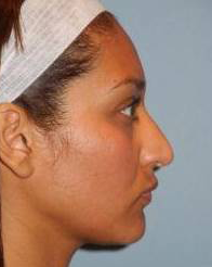 Rhinoplasty case #3513