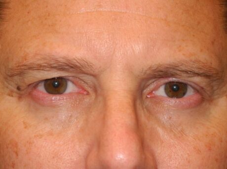 Blepharoplasty case #3977