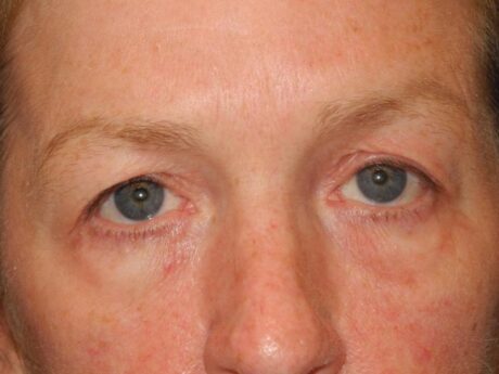 Blepharoplasty case #4024