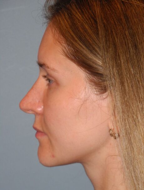 Revision Rhinoplasty case #3435