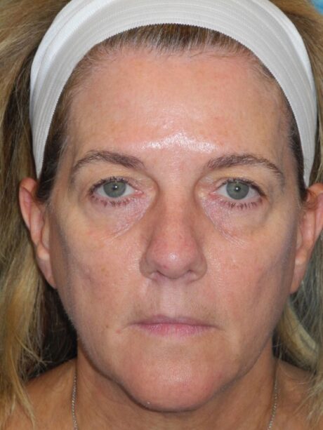 Blepharoplasty case #6472