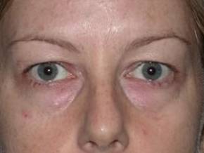 Blepharoplasty case #4050