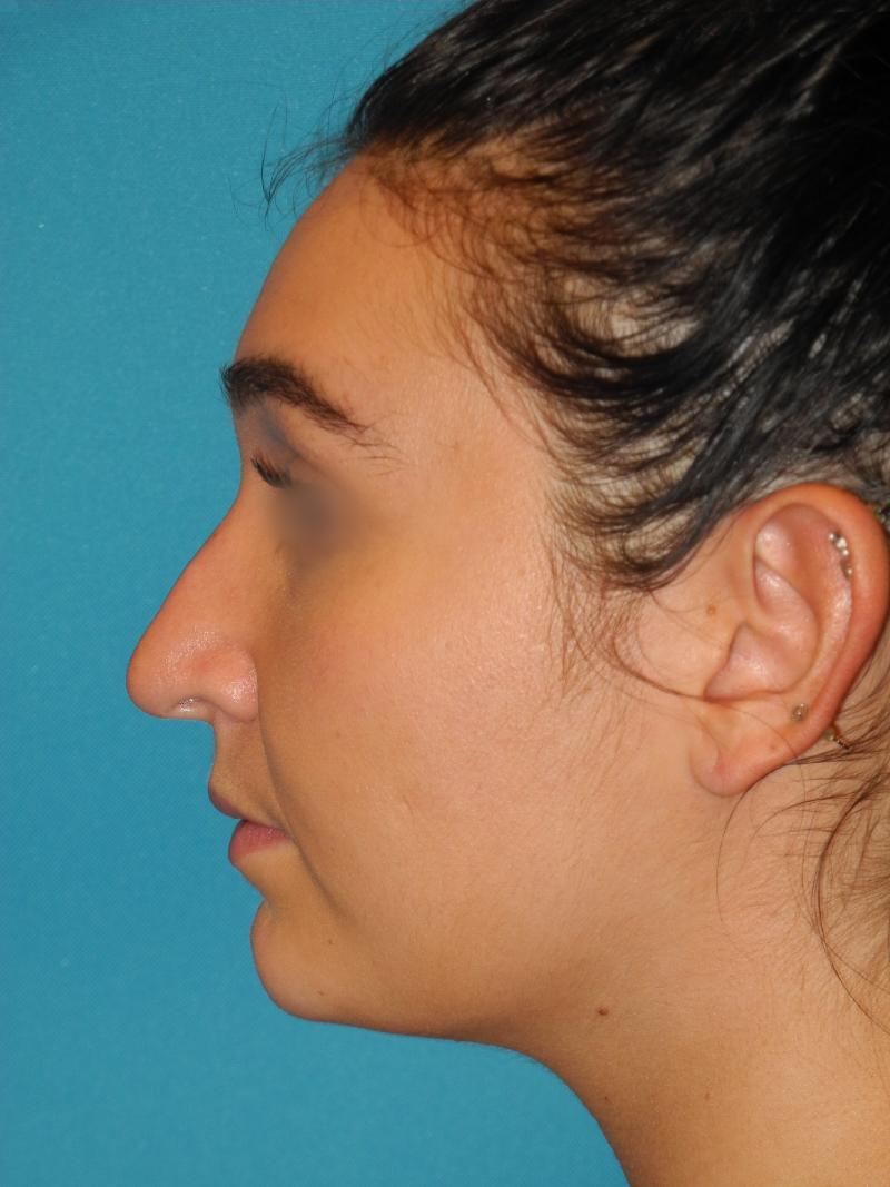 Revision Rhinoplasty case #3466