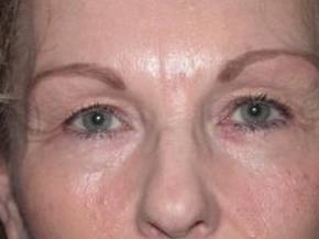 Blepharoplasty case #4058