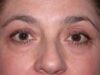 Blepharoplasty case #4083