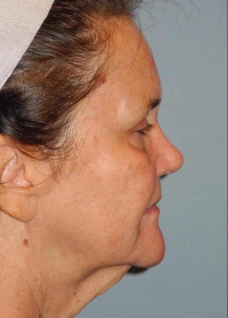 Blepharoplasty case #4086