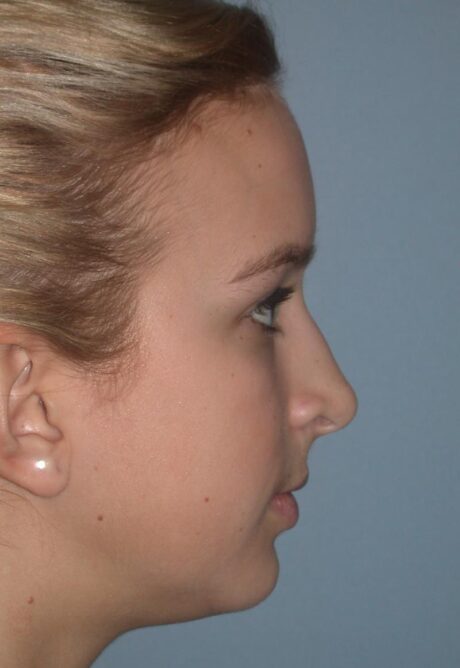 Rhinoplasty case #5414