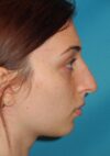 Rhinoplasty case #4122