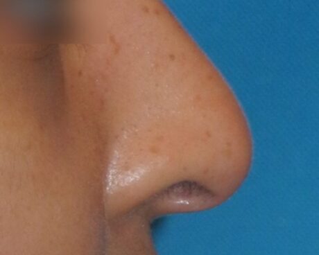 Liquid Rhinoplasty case #4124