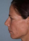 Rhinoplasty case #3515