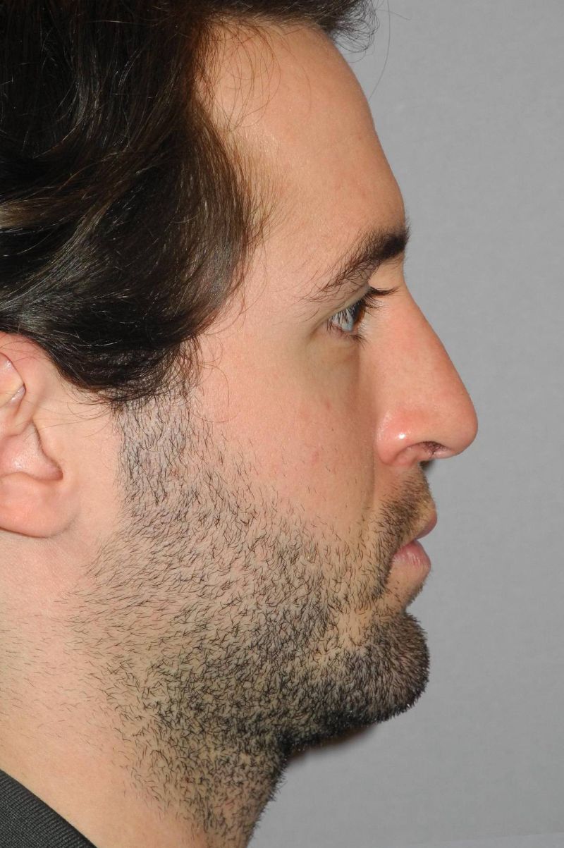 Revision Rhinoplasty case #3467