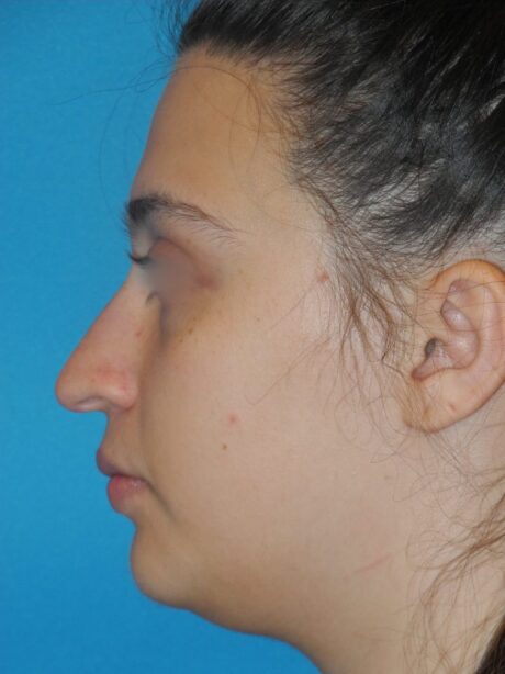 Rhinoplasty case #4126