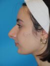 Rhinoplasty case #4168