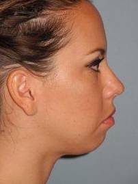 Chin Implant case #4336