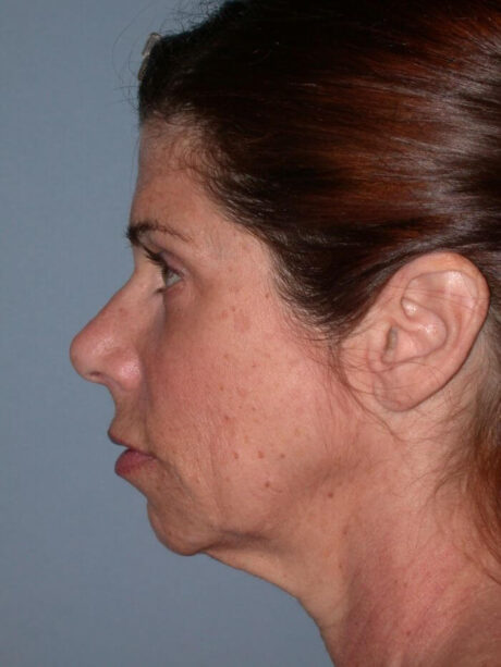 Chin Implant case #4339