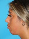 Chin Implant case #4340