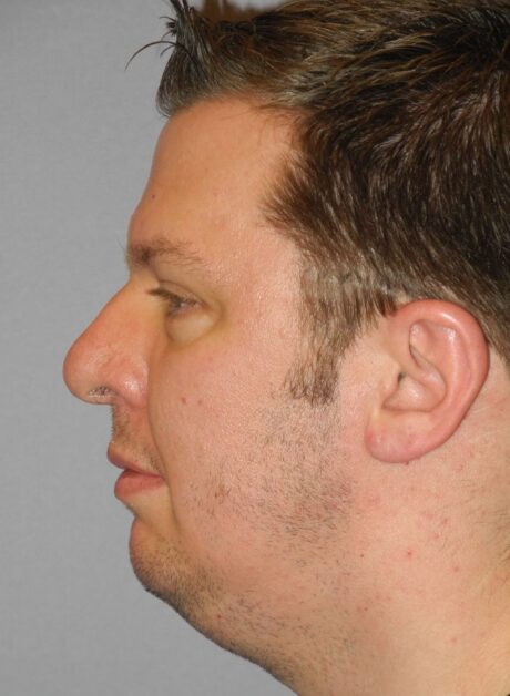 Chin Implant case #4374