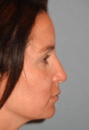 Rhinoplasty case #3690