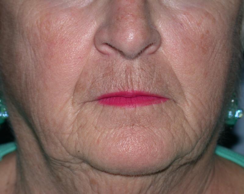 CO2 Laser Resurfacing case #5411