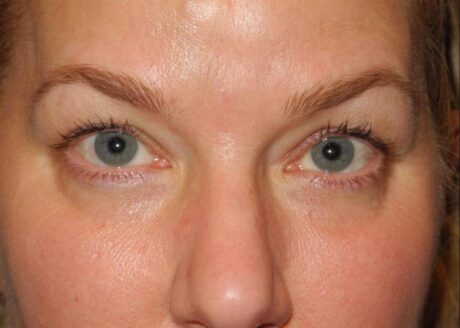 CO2 Laser Resurfacing case #4533