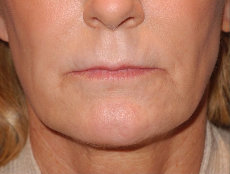 CO2 Laser Resurfacing case #4683