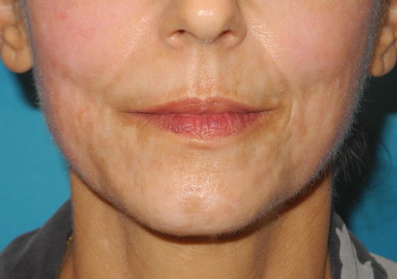 CO2 Laser Resurfacing case #4755