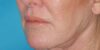 Blepharoplasty case #5235