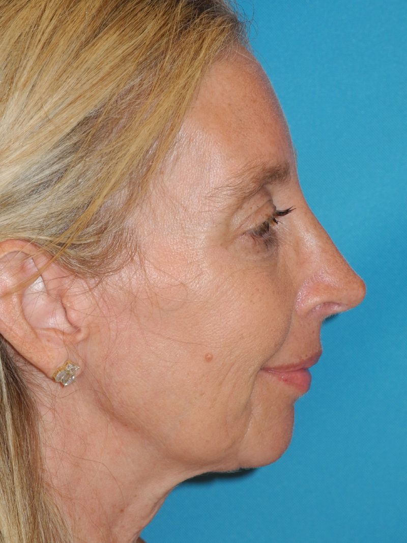 Rhinoplasty case #4166