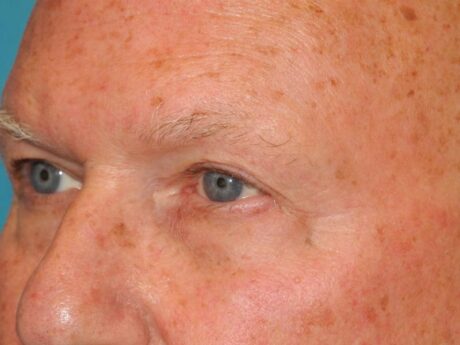 Blepharoplasty case #5211