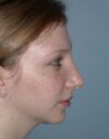 Rhinoplasty case #3510