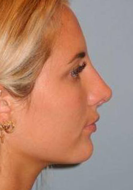 Rhinoplasty case #3691