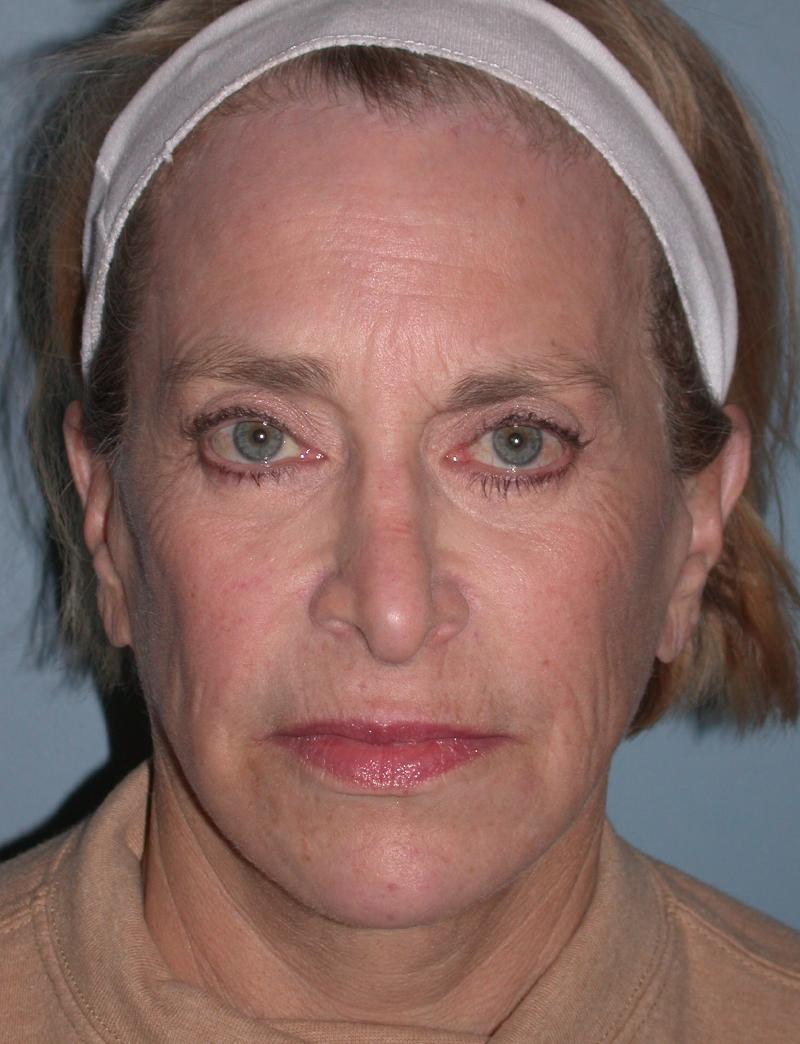 CO2 Laser Resurfacing case #4537