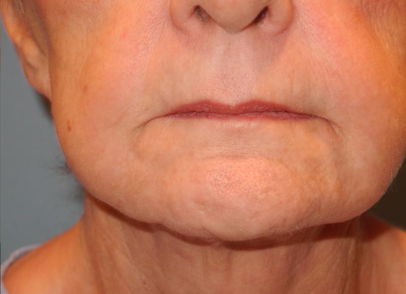 CO2 Laser Resurfacing case #4539