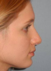 Rhinoplasty case #3692