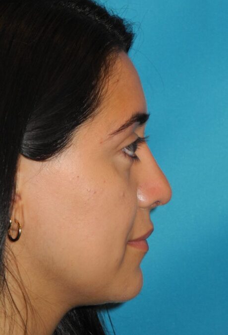 Rhinoplasty case #3518