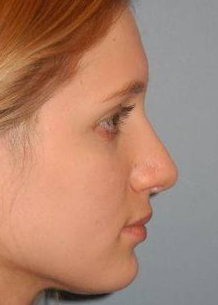 Rhinoplasty case #3692