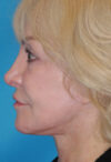 CO2 Laser Resurfacing case #4635