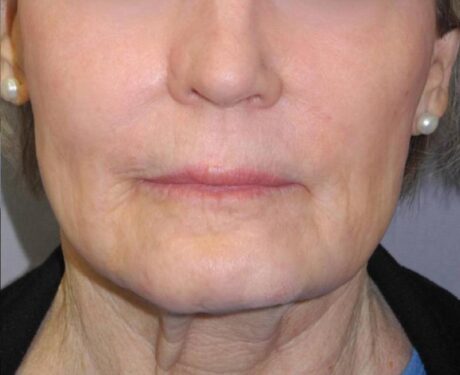 CO2 Laser Resurfacing case #4638