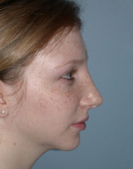 Chin Implant case #3577