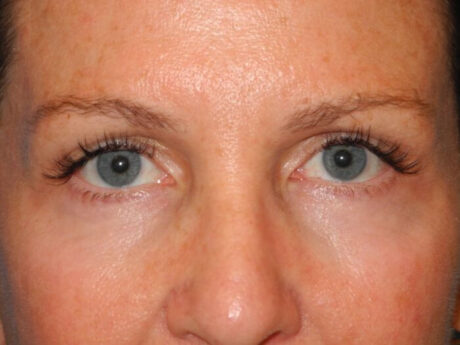 CO2 Laser Resurfacing case #4685