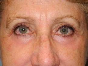 Blepharoplasty case #4764