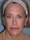 Blepharoplasty case #6469