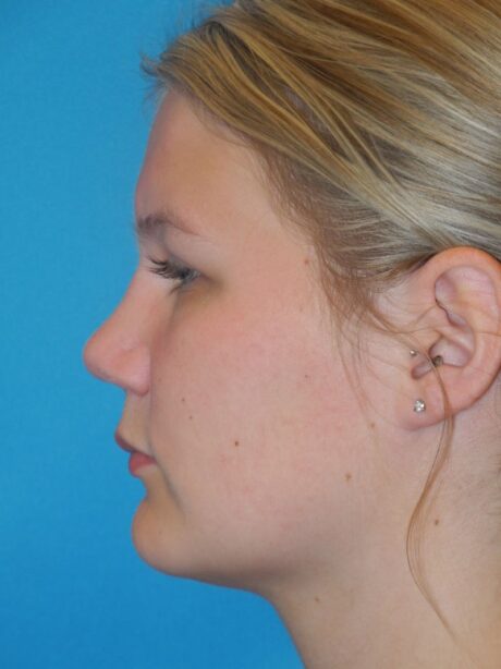 Rhinoplasty case #3511