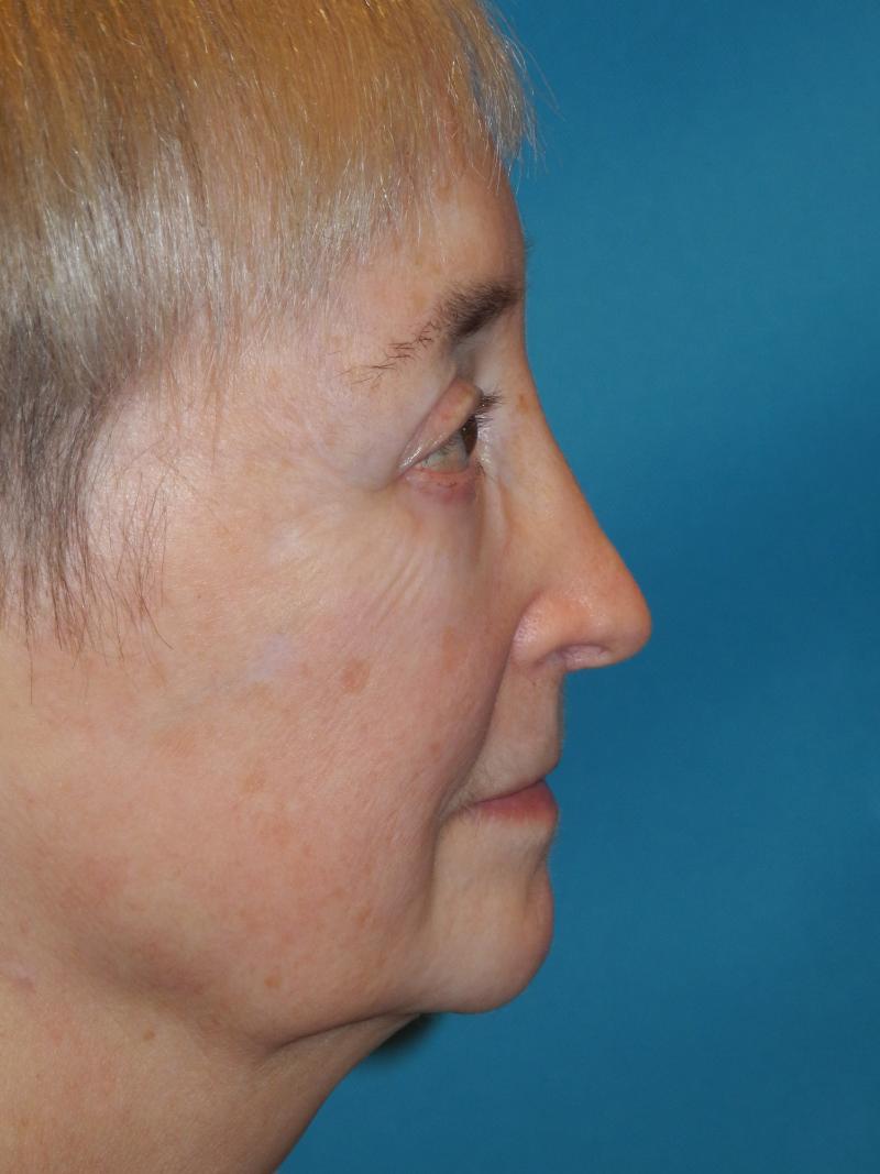 Blepharoplasty case #4858