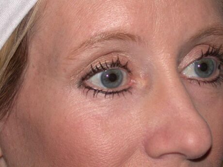 Blepharoplasty case #4941